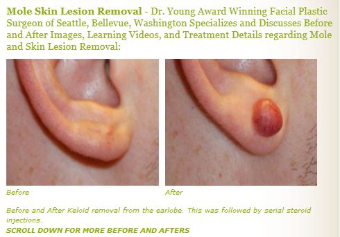keloid scar treatment before after images