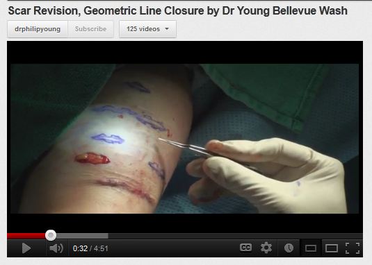 scar treatment geometric line closure video