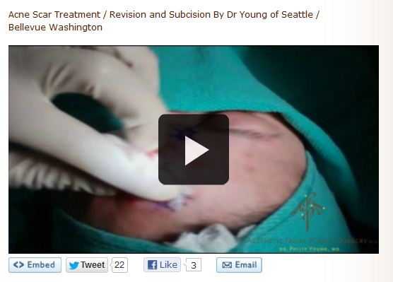 acne subcision video