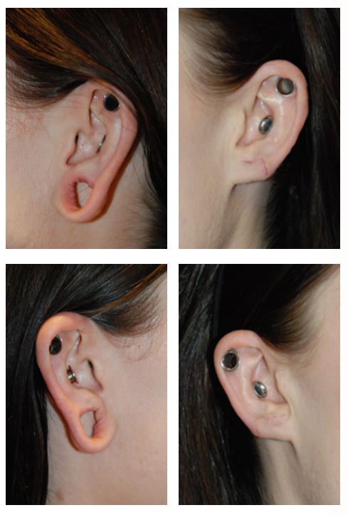 gauged earlobe repair