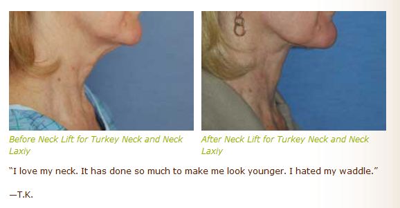 neck lift before after images