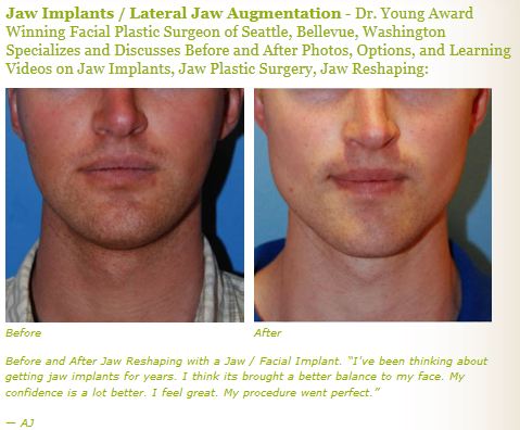 jaw implant augmentation