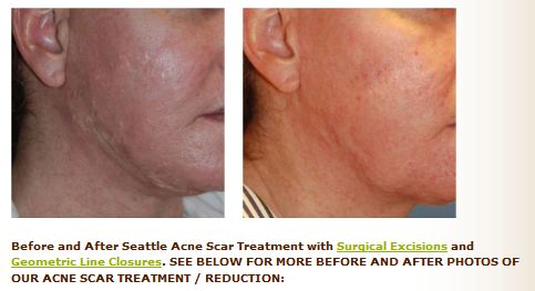 Acne Scar Treatment Before After
