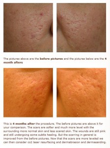 acne scar subcision tca cross treatment images