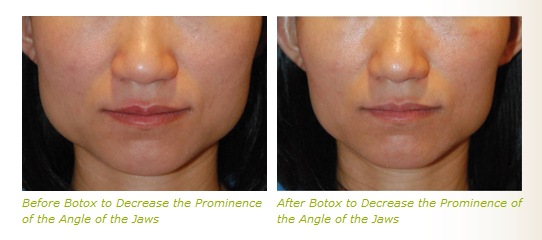 dysport jaws, botox jaws, jaw reduction, jaw shaping