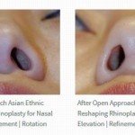 Rhinoplasty Open Approach Incision Dr. Philip Young