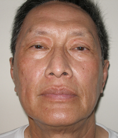 Asian Ethnic Laser Resurfacing After Picture
