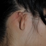 Microtia Ear Congenital deformity Dr. Philip Young Bellevue | Seattle