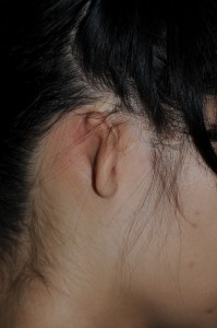 Microtia Ear Congenital deformity Dr. Philip Young Bellevue | Seattle