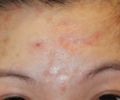 Atrophic Forehead Scar Example from Acne by Seattle's Dr. Philip Young