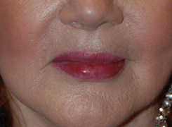 After Restylane Injections / Lip augmentation