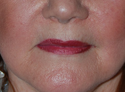 Before Restylane Injections / Lip augmentation