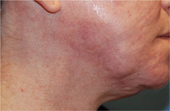 After Acne Scar co2 Laser Treatment