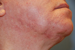 After Acne Scar Excision / Camouflage Techniques