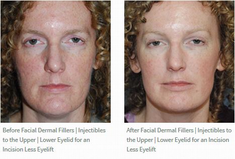 Fillers Upper Lower Eyelid Eyelift