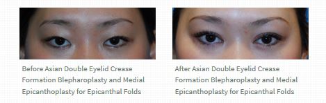asian-bleph-double-eyelid-crease-before-after