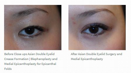 asian-double-eyelid-crease-before-after-left-eye