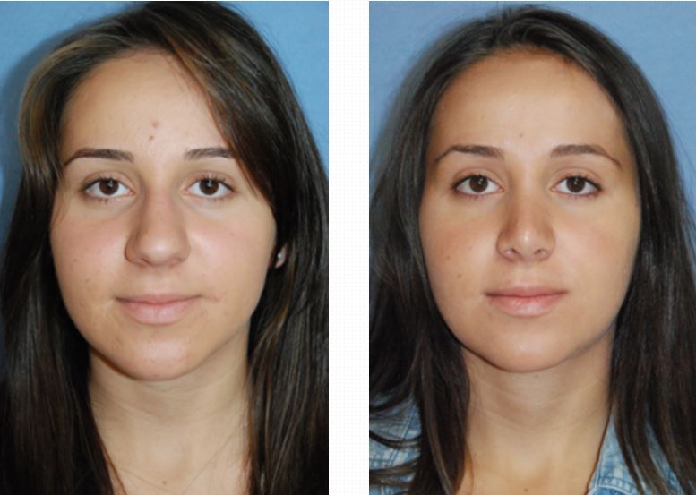 rhinoplasty-before-after-images