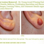 keloid scar treatment before after images