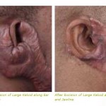 keloid scar treatment ear jawline