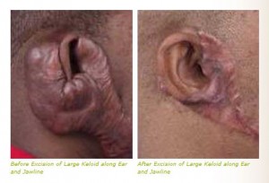 keloid scar treatment ear jawline