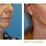 mini face lift before after