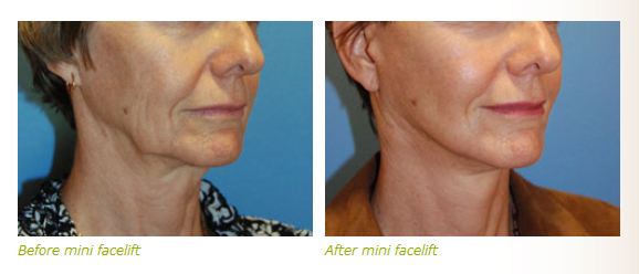 mini face lift before after pictures