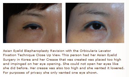 ptosis repair for asian eyelid procedure