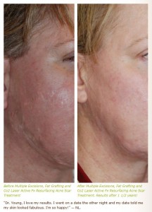 acne scar treatment with excision