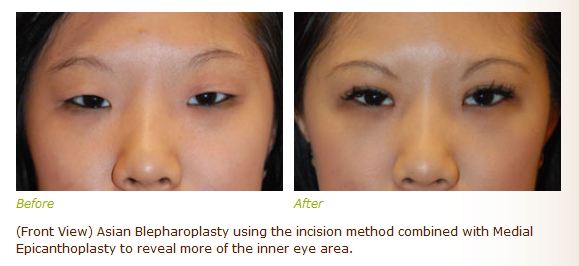 asian double eyelid before and after pictures