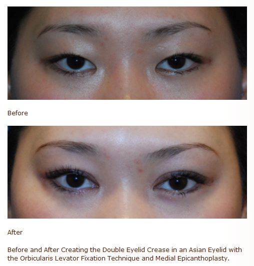 asian double eyelid medial canthoplasty surgery before after