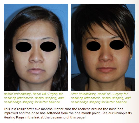 asian rhinoplasty before after images