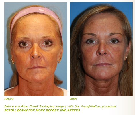 cheek lift with youngvitalizer