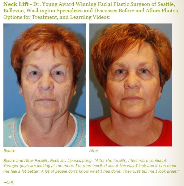 neck lift before after pictures