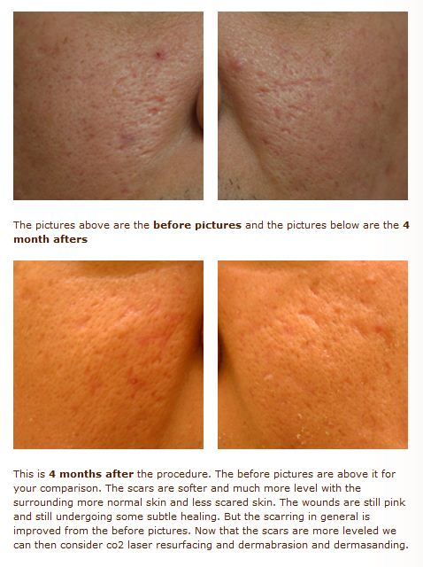 Acne Scar Treatment Healing Diary Released By Dr Philip Young Seattle