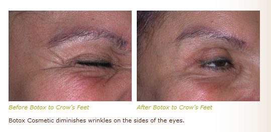 botox dysport crows feet