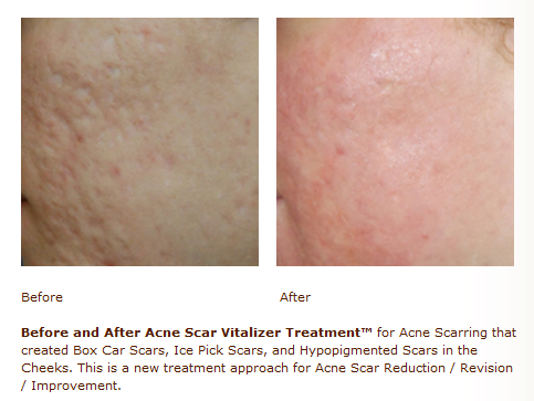 acne scar treatment, acne scar reduction