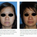 asian rhinoplasty before after