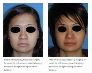asian rhinoplasty before after