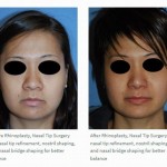 Rhinoplasty asian before after wide nose nostril