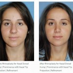 Rhinoplasty before after for Middle Eastern Persian Patient