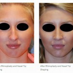 Rhinoplasty Nasal Tip Narrowing Hump Removal before after