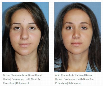 Rhinoplasty before after for Middle Eastern Persian Patient