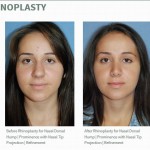 Rhinoplasty Reviews Dr. Philip Young