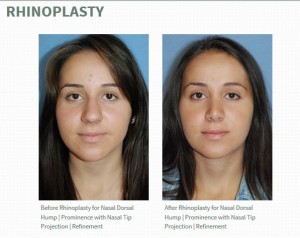 Rhinoplasty Reviews Dr. Philip Young