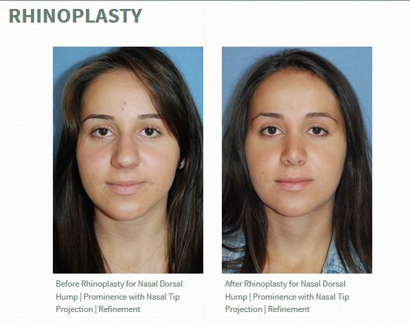 Rhinoplasty Before and Afters by Dr. Philip Young