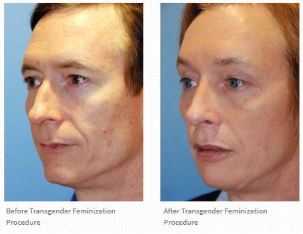 Reviews | Testimonials for Dr. Philip Young Seattle | Bellevue and his work on Transgender Facial Feminization | Masculinization