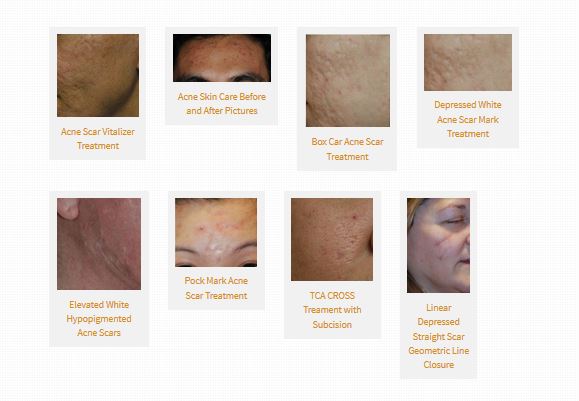 acne scar treatment photo directory