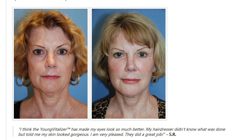 YoungVitalizer Incision Less Face Lift