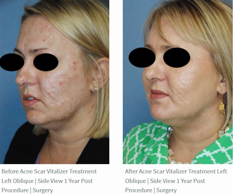acne scar vitalizer treatment before after